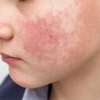 Pofoncsapott arc: így ismerheti fel időben a lepkehimlőt