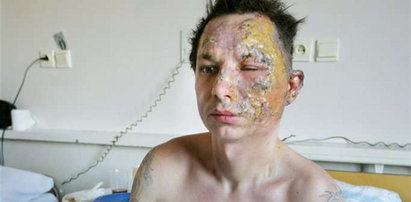 Bandyta spalił mu twarz