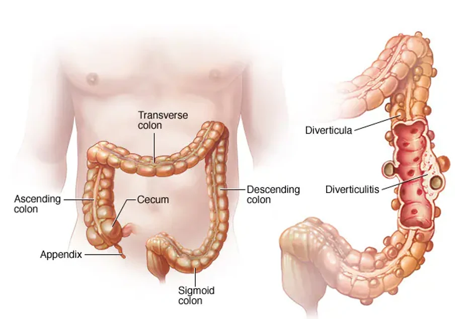 Divertikule su male, izbočene kesice koje se formiraju u zidu debelog creva, najčešće u donjem delu creva