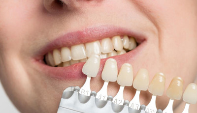 Nakładkowe wybielanie zębów. Przebieg, cena i skutki uboczne