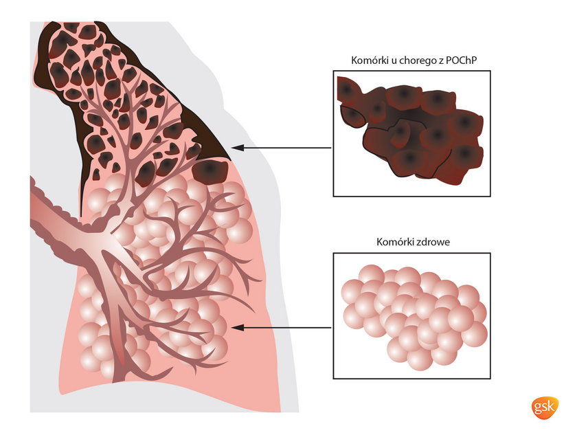 Komórki płuc