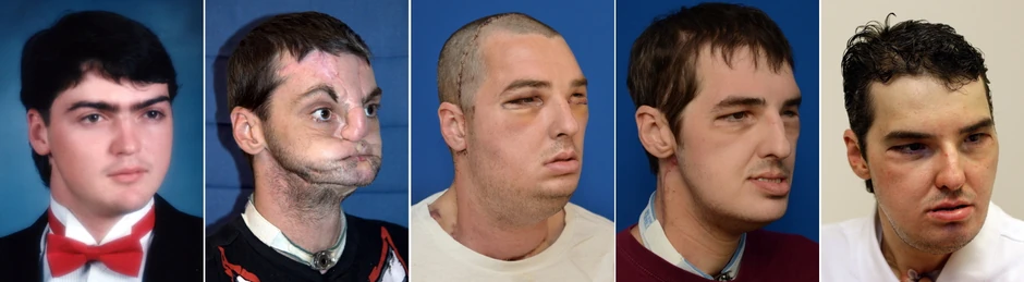 Ričard Noris pre nesreće, posle, pa nakon operacija