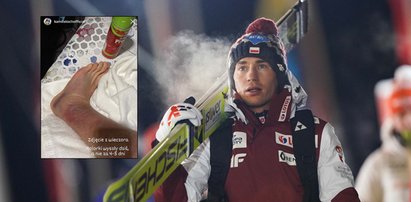 Kamil Stoch pokazał zdjęcie kostki. To nie jest przyjemny widok