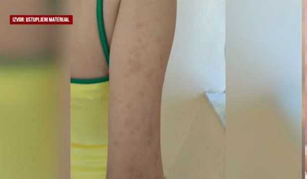 Ujed stenice