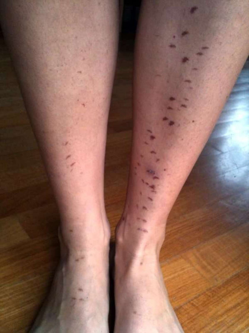 Straszne skutki depilacji: Poparzył mnie laser!