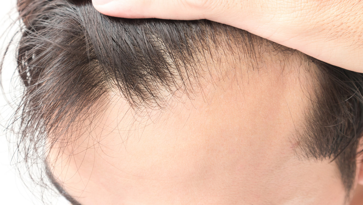 Nadmierna utrata włosów nie zawsze związana jest z wiekiem. Czasem łysienie zaczyna się znacznie szybciej. Niezależnie od tego, co jest jego przyczyną, znaczne przerzedzenie włosów to wstydliwy problem. Jak z nim najskuteczniej walczyć?