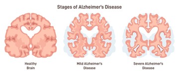Bár az Alzheimer kórban az idegsejtek pusztulásának okát nem tudjuk megmondani, felvetődött, hogy a beta-amyloid egy bizonyos formája okozhatja. Amyloid prekurzor (előalak, képző) fehérje, valamint a preszenilin 1 és preszenilin 2 fehérjék bizonyos genetikai mutációi (a gén örökíthető megváltozásai) korai kezdetű Alzheimer betegséghez vezethetnek. Ezek a mutációk amyloid plakkok kialakulását eredményezik.