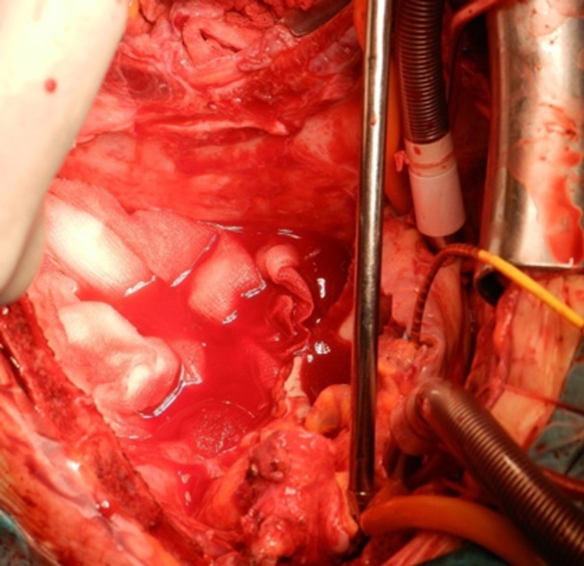 Bolesno srce je izvađeno, a srčana kesa je pripremljena da primi novi organ