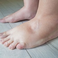 Ödéma - ezzel az egyszerű módszerrel megtudhatja, milyen stádiumban van