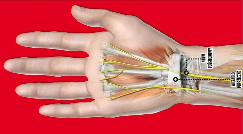 Zespół cieśni nadgarstka. Może i Ciebie dotyczy ten problem?
