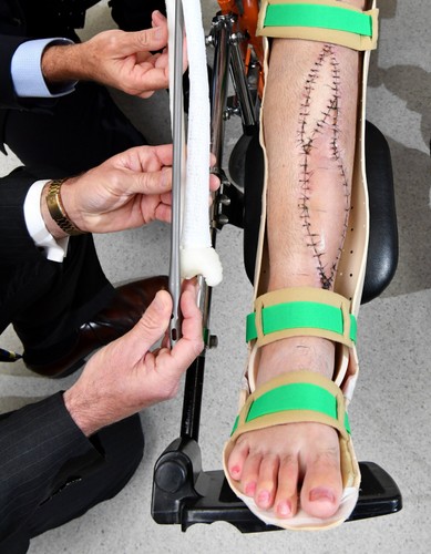 ODTWORZYLI KOŚĆ DZIĘKI DRUKARCE 3D