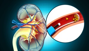 Kamen u bubregu jako boli kada dolazi do njegovog izbacivanja 