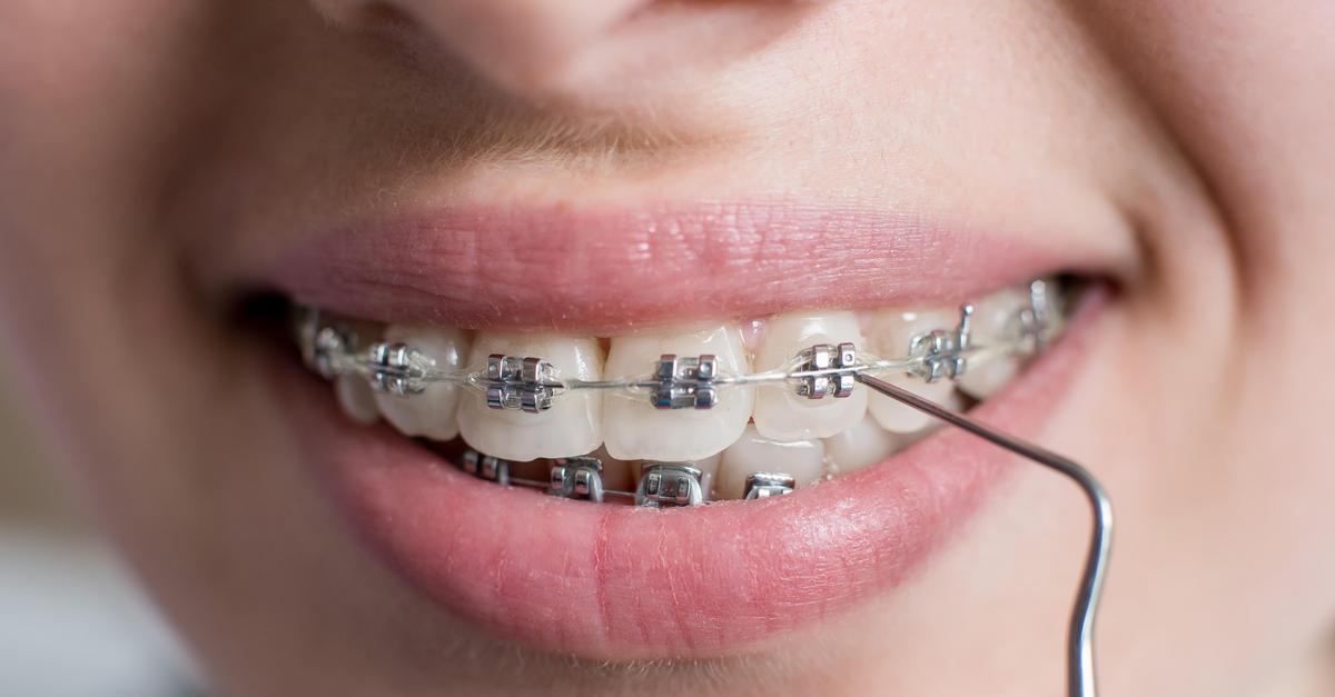 Jak Przygotowac Sie Do Zalozenia Aparatu Ortodontycznego