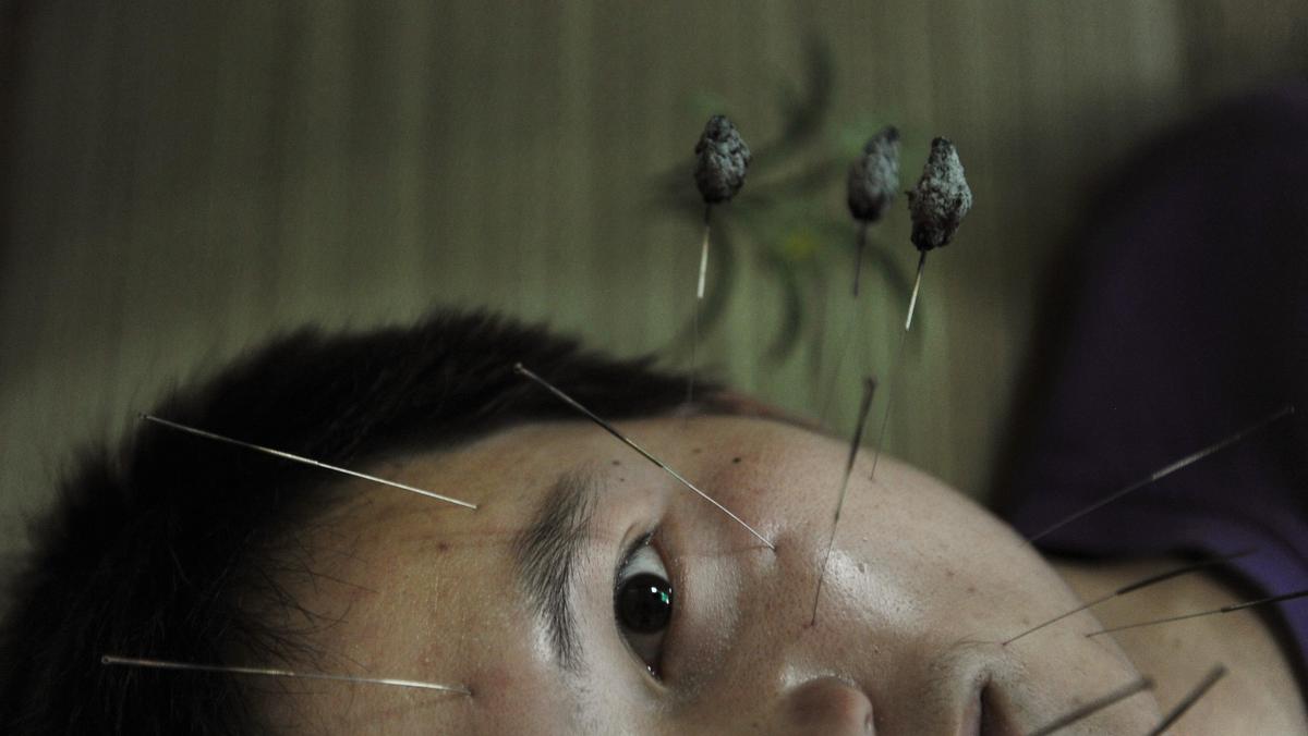 A patient suffering from facial paralysis undergoes acupuncture treatment at a traditional Chinese m