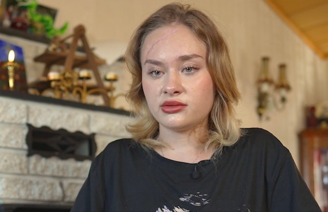 Marija kovalčuk ima ogroman ožiljak preko celog čela