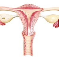 Kiderült, mi okozza pontosan a PCOS-t - Így lehet kezelni