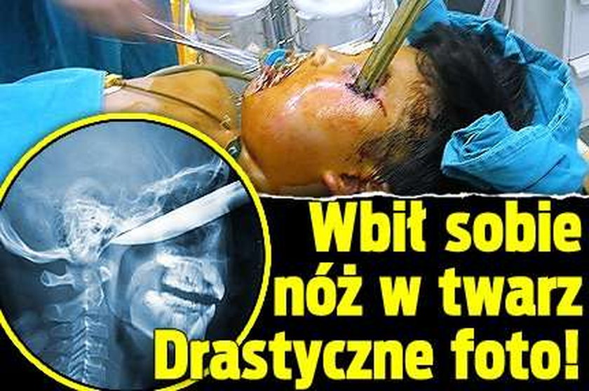 Wbił sobie nóż w twarz. Drastyczne foto!