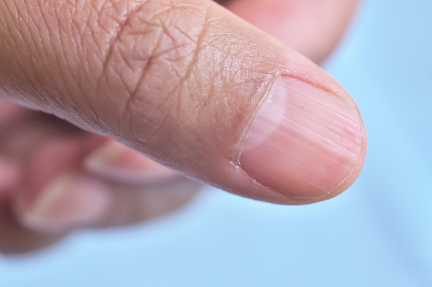 Fizička trauma ili hronična oštećenja nokta mogu da doprinesu razvoju melanoma noktiju