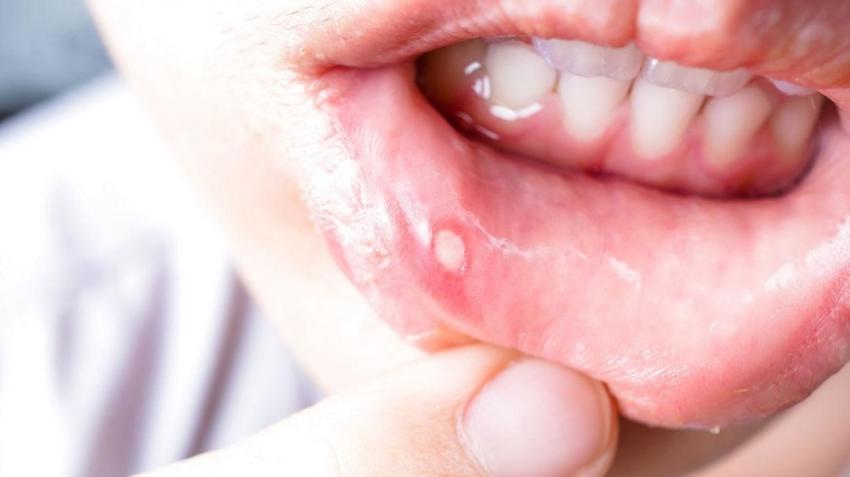 Herpeszes száj- és ínygyulladás: ez az oka, tünete és kezelési módja |  EgészségKalauz