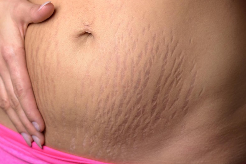 Pregnancy causes stretch marks