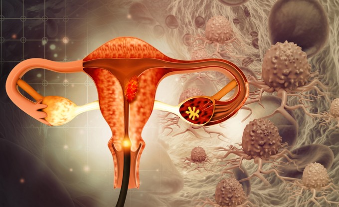Miómával diagnosztizálták? Ezt lehet tenni ellene