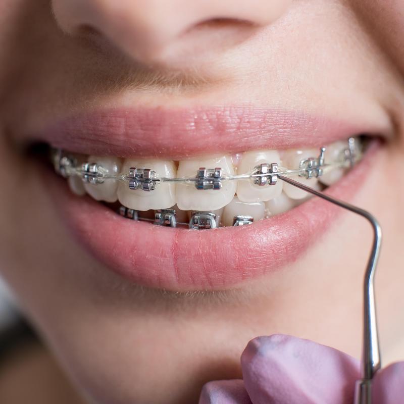 Jak Przygotowac Sie Do Zalozenia Aparatu Ortodontycznego