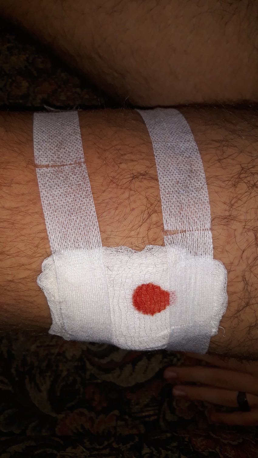 NIS01 Krvava rana na nozi dečaka B.P. koga je ujeo pas rase akita