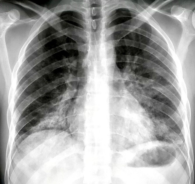 Pneumonija koju izaziva kovid-19 javlja se u najtežim slučajevima