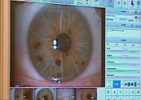 100 látás-helyreállító műtét, A retina problémáinak okai és jelei