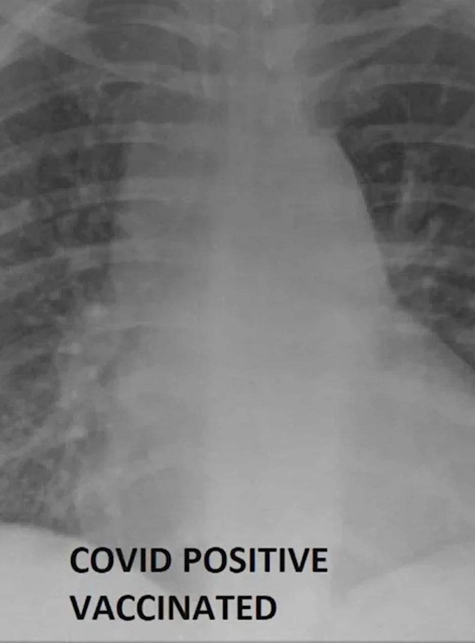 Rendgenski snimak vakcinisanog pacijenta obolelog od kovida