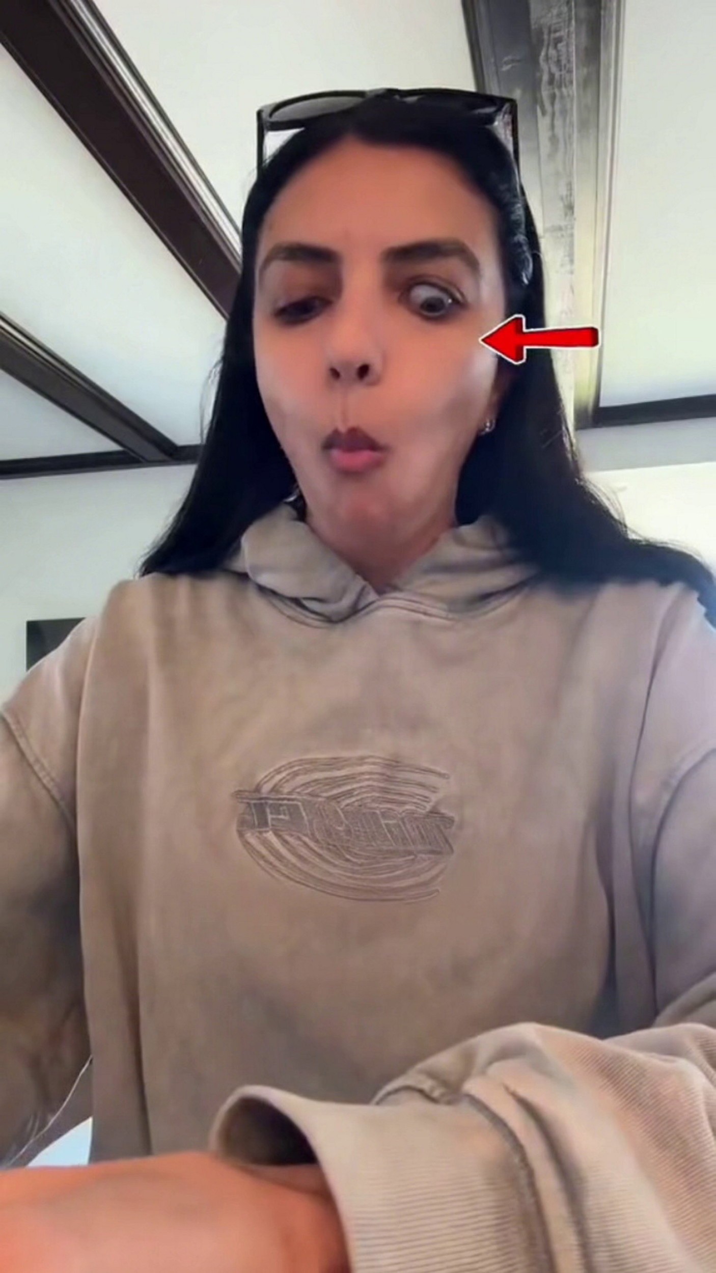 Pohyb čeľuste spôsobuje Marion vypúlenie oka.