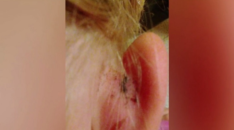 A tanár úgy megtépte a kislány fülét, hogy az sebes lett / Fotó: Tv2