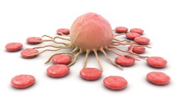 Zespoły mielodysplastyczne - mało znany nowotwór krwi. Częstszy niż białaczka