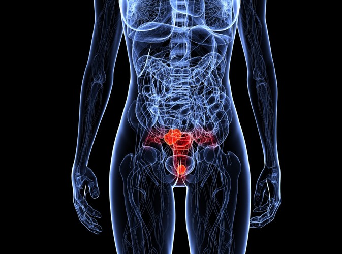 Czym są mięśniaki macicy