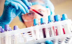 Sprawdź, czy masz wirusa HCV, wywołującego raka. Darmowe testy