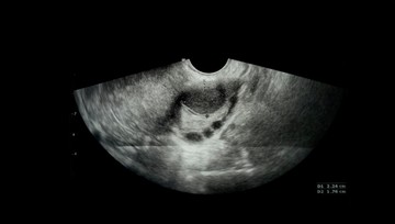 A diagnózist felállító orvos számára a legtöbb segítséget az ultrahangos vizsgálat nyújtja. A legfontosabb eldöntendő kérdés, hogy az elváltozás rosszindulatú, vagy sem. A termékeny korban lévő nők esetében a petefészekciszta gyakran jóindulatú, sokkal jellemzőbb a rosszindulatú elváltozás a változókor után.
