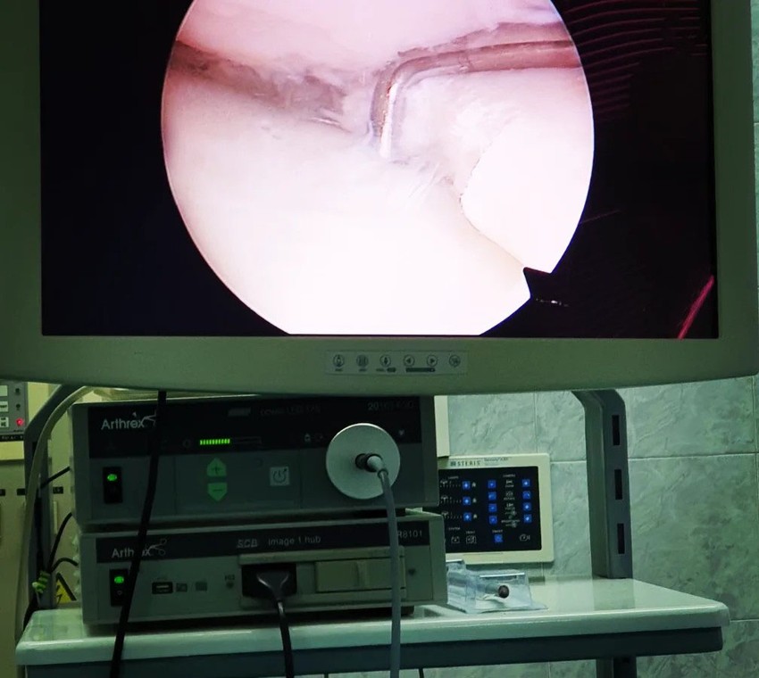 Malim instrumentima se ulazi u koleno i rešava veliki problem