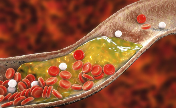 Hipercholesterolemia rodzinna groźniejsza od „zwykłego” podwyższenia cholesterolu