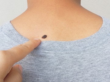 melanóma, bőrrák, bőrdaganat, anyajegy, noduláris melanoma
