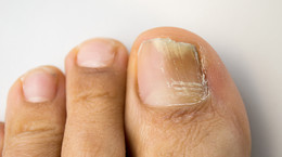 Grzybica paznokci - przyczyny, objawy, leczenie, jak jej uniknąć