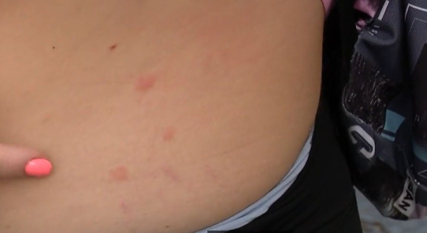 Ujedi stenica na jednoj od stanarski zgrade