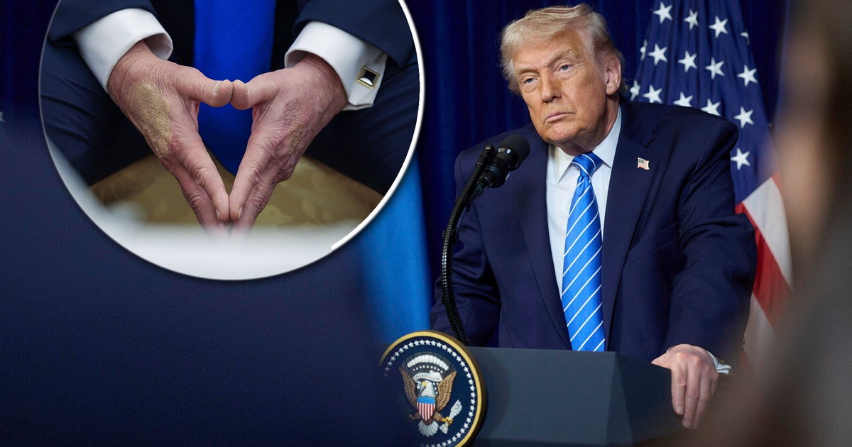 Sine ręce Trumpa to nie przypadek. Prezydent USA ujawnił w końcu prawdę