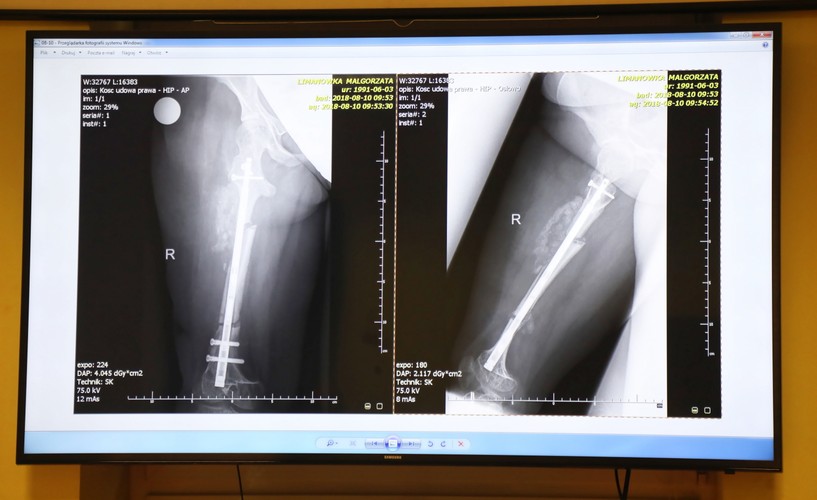 INNOWACYJNA OPERACJA WYDŁUŻENIA KOŚCI