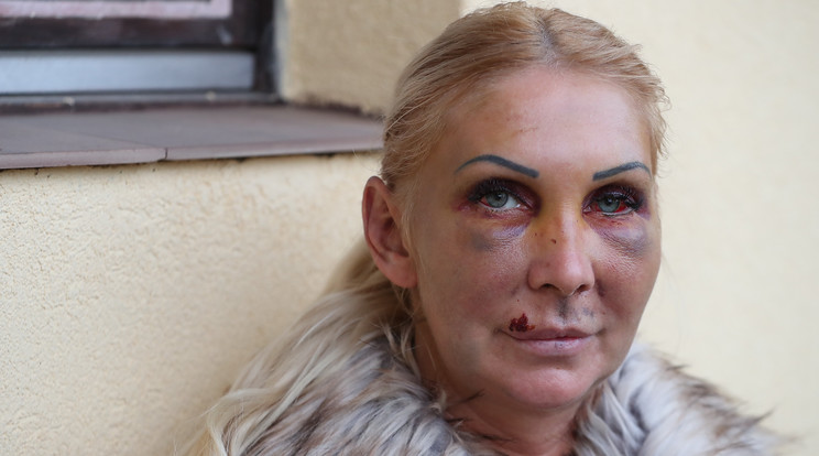 Orosz Bernadettet volt párja bántalmazta súlyosan /Fotó: Pozsonyi Zita