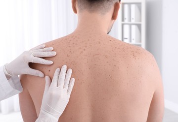 anyajegyszűrés, dermatológus, anyajegy, bőrrák, melanoma