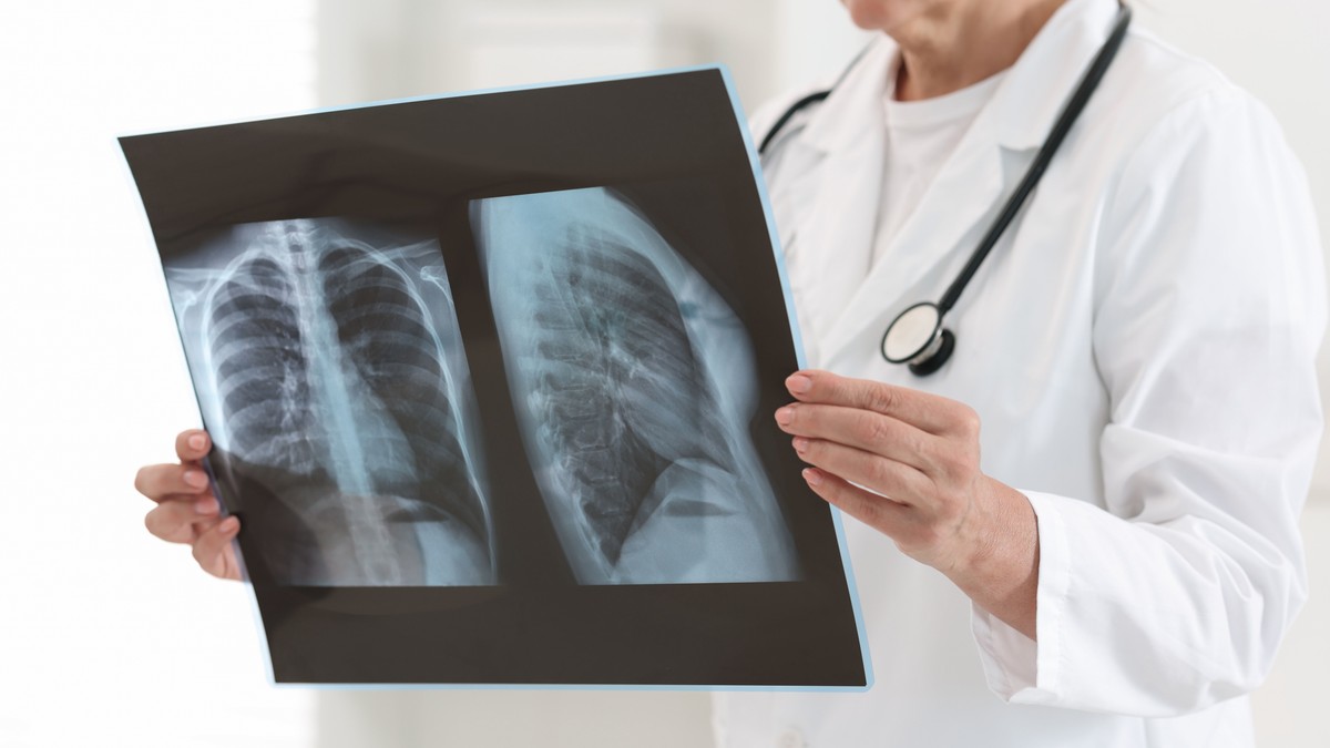 Kakva je to veza između raka pluća i krvnih ugrušaka 