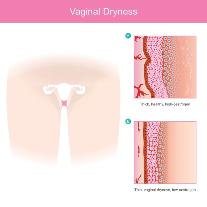 Vaginalna suvoća / ilustracija