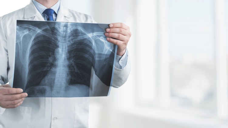 COPD, tüdő, dohányzás, nehézlégzés, légszomj