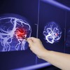 Proširenje arterija ključni uzrok lakunarnog ishemijskog moždanog udara