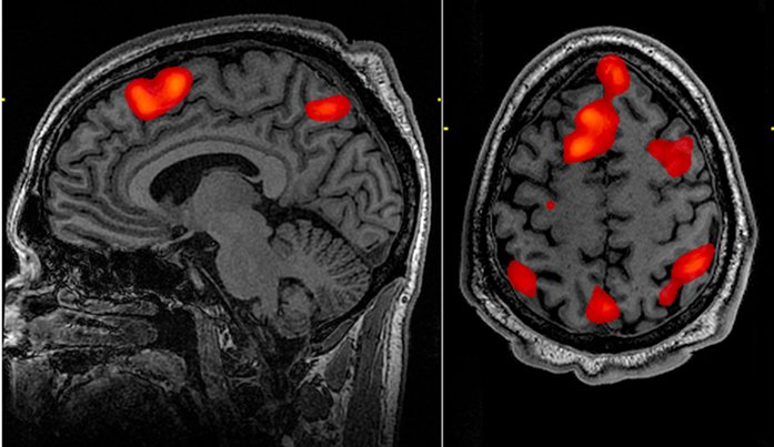 Obraz aktywności mózgu otrzymany w wyniku badania funkcjonalnym rezonansem magnetycznym - FMRI